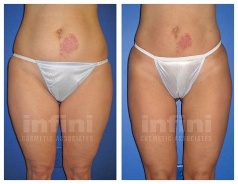 They may be pimples, or other type of lesions that appear like pimples. Female Inner Thigh Liposuction Before and After | Infini ...