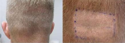 Hair transplant & restoration in los angeles. Fue Hair Transplant Los Angeles | Dr. Sean Behnam