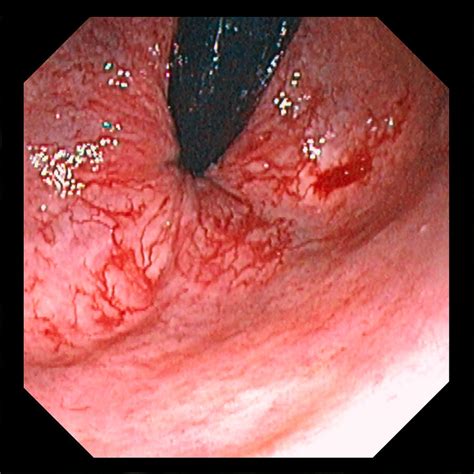 Internal hemorrhoids in females (picture 8) are more common and have fairly vivid symptoms. Bleeding Haemorrhoids Photograph by David M. Martin, Md