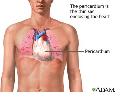 Get medical advice if you have chest pain. Pericarditis - constrictive: MedlinePlus Medical Encyclopedia