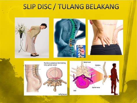 Check spelling or type a new query. Just Klik!: Slip Disc & Sakit Belakang