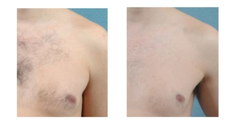 What you can expect for chest laser hair removal is a little bit longer of sessions. Hinsdale Laser Hair Removal For Men | Laser Aesthetic Center