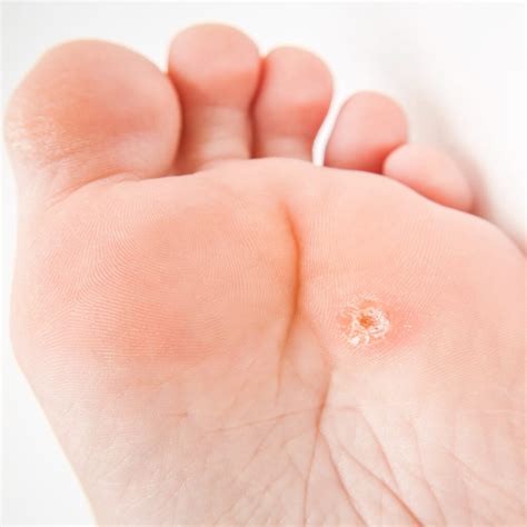 A hardened, raised bump 3. Corns and Calluses - Brampton Foot Clinic