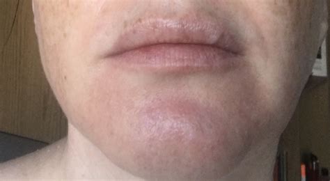 My zucchini plants took off. Why is my chin always red? With pic ( I don't think it's ...