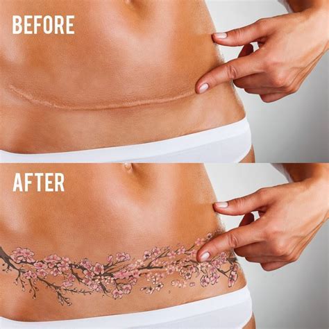 Having medicare coverage is needed to get health fund coverage. Image result for pictures of tattoos to cover stretch ...
