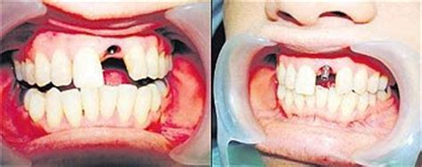 Cari tahu lebih jauh tentang gigi ini. Dentistry Today