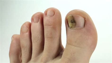 The fungal disease, also known as onychomycosis or unguium, is an inherent disease of the toenail pads and plaque. Toenails with Fungal Infection. Sick Stockvideos ...