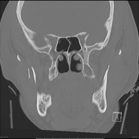 Mandibular fractures | Image | Radiopaedia.org