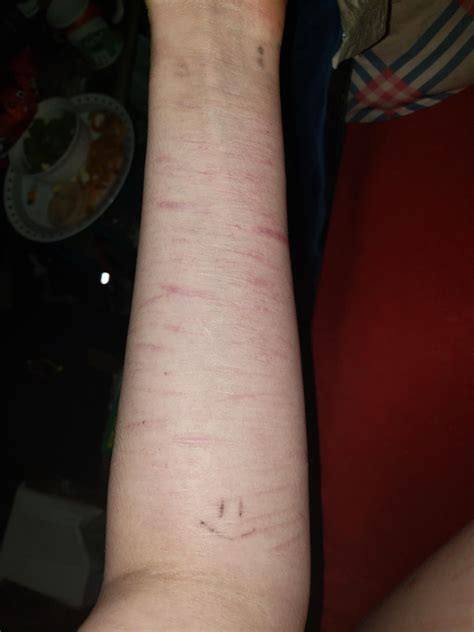 For that matter, for me it never feels good at all. Part of my self harm scars looked 1/10 what it used to ...