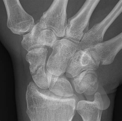 Scaphoid fractures - Avanthi Mandaleson