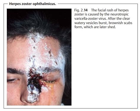 Any branch of the nerve may be. Herpes Zoster Ophthalmicus