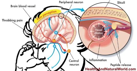 12 ways to get rid of a headache, besides taking ibuprofen. Top 15 Causes of Headaches and How to Get Rid of Them ...