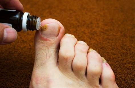 The overgrowth of fungus in the skin of the foot is more commonly referred to as athlete's foot or tinea pedis. Foot fungus types pictures - Awesome Nail