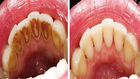 Wie putzt der patient seine zähne und wie häufig? VIDEO: So einfach entfernst du Zahnbelag ohne zum Zahnarzt ...