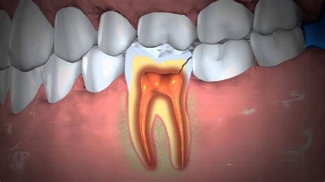 Will antibiotics help with the pain associated with a tooth infection? Dental Health : Home Remedy for an Abscessed Tooth ...