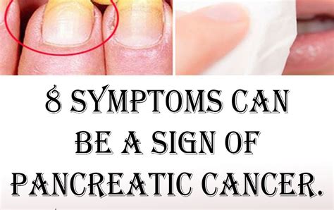 This is caused by the release of pancreatic. 8 symptoms that can be a sign of pancreatic cancer. You'd ...
