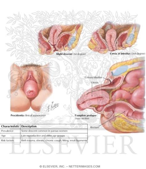 Once the prolapsed uterus has been replacement no retention sutures are needed. Uterine Prolapse