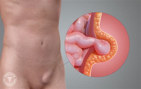 Check spelling or type a new query. Patient Information on Inguinal Hernia | Apollo Clinic ...