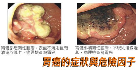 胃癌（stomach cancer、gastric cancer）是發生在胃部黏膜的癌症。 早期的症狀包括胃灼熱，上腹疼痛，惡心及食慾不振。 症狀與消化性潰瘍類似，是導致延誤就醫與高死亡率的原因，但其痛感與潰瘍還是有些許差異，胃潰瘍. 胃癌早期無症狀 內科醫師揭十大致癌因子：原來連血型也有影響？