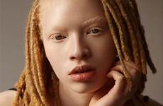 albino locs beautiful dreads model hair people von dreadlocks blonde dreadlock natural styles curly albinism sisterlocks man nattes instagram gemerkt