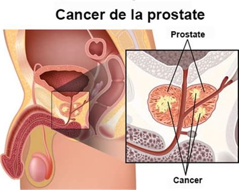 Prostate cancer awareness products this category includes products featuring the light blue ribbon representing prostate cancer awareness. Traitement du cancer de la prostate : traitement ...