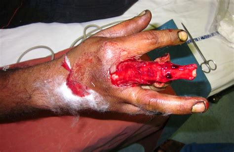 RING AVULSION INJURY MIDDLE FINGER - GROIN FLAP COVER - RESULTS. - HAND ...