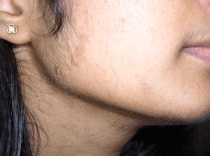 If you have chin hair, it could mean something bigger is going on in your body. Pin on Female Sideburns