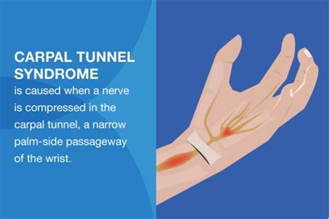 Both sides should have similar strength and flexibility regardless of which hand is more dominant. 5 carpal tunnel relief products you need at work