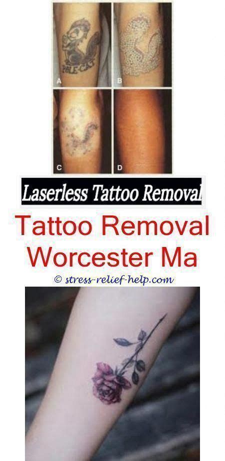 Smoking, ink color affect laser tattoo removal. professional tattoo removal tattoo removal blue ink - blue ...