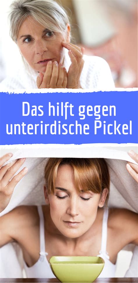 Habe seit 3 jahren starke pickelmale & wollte mal fragen, ob ihr tipps für mich habt? So werden Sie unterirdische Pickel am besten los | Pickel ...