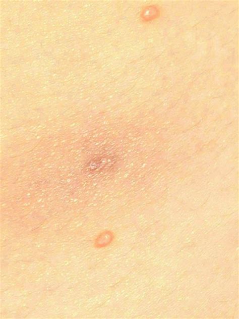 Which types of doctors treat molluscum contagiosum infections? Molluscum Pictures: Infection After Piercing Molluscum Bump