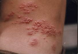 Symptoms generally include a rash of the forehead with swelling of the eyelid. Shingles Herpes Zoster - Lone Parenting