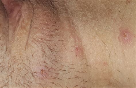 Looking at pictures, an ingrown follicle appears almost similar to a raised red pimple. Infected/ingrown hairs or herpes..? | Sexual Health ...
