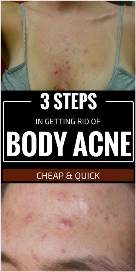 So if you are reading this post, and you probably have acne your trying to get rid of,i. Aktive Bestandteile DRINGEN in die Oberhaut ein | Body ...