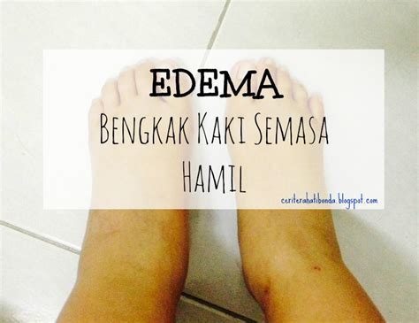 Definisi kaki bengkak semasa hamil atau edema. Tips Semulajadi Kurangkan Bengkak Kaki Semasa Hamil ...