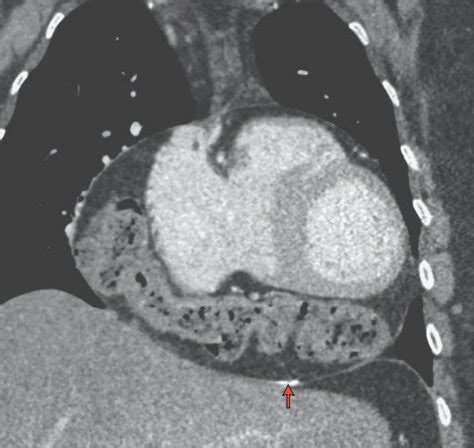 L'électrocardiogramme montre des signes typiques : Des palpitations cardiaques qui s'atténuent quand la ...