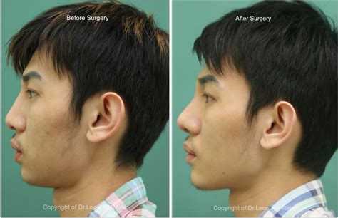 Licuala is represented by 41 species, including 15 newly described, in the malay peninsula. Revision Rhinoplasty - Elegant Plastic Surgical Centre in ...