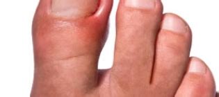 What causes infections in ingrown toenails? Ingrown Nails. Causes, symptoms, treatment Ingrown Nails