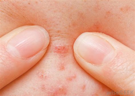 'however, some cystic acne needs oral therapies to be given in conjunction with a topical treatment to control it.' What is Salicylic Acid Ointment? (with pictures)