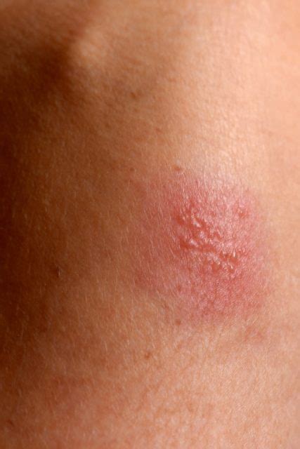 I also thinks it's awesome that you have built up a nice little nest egg for yourself. Living with Herpes | causes, symptoms, how to deal with ...