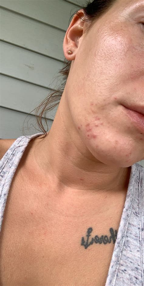 As it gets worse, it can spread to the rest of the face and other parts of the body. acne I'm unsure if this is fungal or hormonal acne. I ...