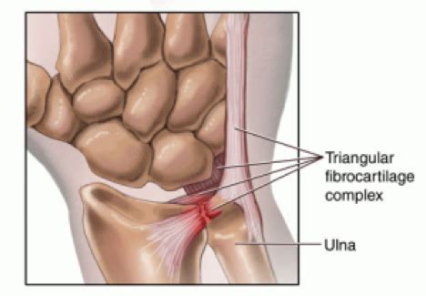 Triangular fibrocartilage complex (tfcc) injury is an increasingly recognized problem that can arthrex provides solutions for capsular repair of the superficial tfcc as well as superficial and deep. What is the TFCC? How do you Treat it? - Rehab U Practice ...