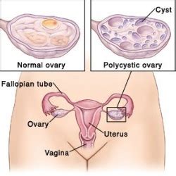 Is it possible for a couple to get pregnant quickly? 9 TIPS TO GET PREGNANT WITH PCOS | Lady Care Health