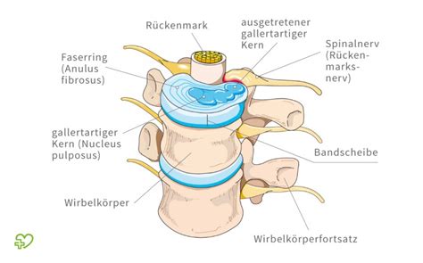 Eine matratze sollte immer optimal auf den schläfer abgestimmt sein, d. Bandscheibenvorfall: Symptome, Dauer, Behandlung - Onmeda.de