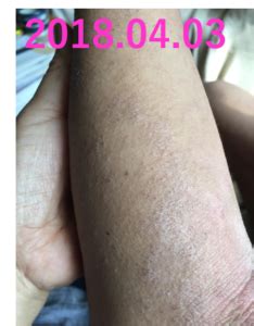 ★14歳 Kくん★ アトピー（小麦で悪化、写真あり） - アトピーや ...