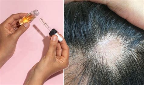 This is because the standard western diet already contains far too much of these fatty acids. Hair loss treatment: Stop alopecia areata with sesame oil ...