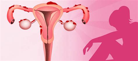 Symptoms, causes, diagnosis, and treatment. Una enfermedad oculta por la creencia de que la ...