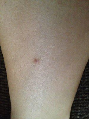 To gather more information on ingrown hairs under your arms how do you treat an ingrown hair at home? Ingrown hair on leg help! | Beautylish