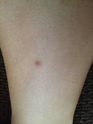 Though these do not pose a great threat to health but are quite irritating and unsightly. Ingrown hair on leg help! | Beautylish