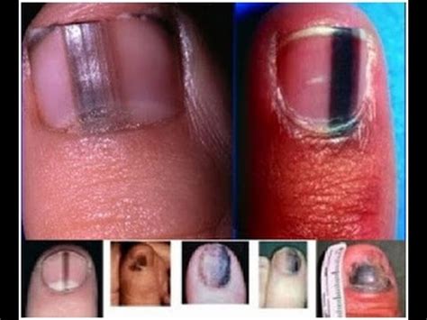 Penyakit kuku (nail disease) terdiri daripada pelbagai jenis. BAHAYA ! Jangan Sepelekan Tanda Hitam Pada Kuku. Bisa Saja ...